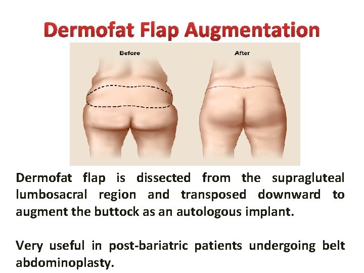 Dermofat Flap Augmentation Dermofat flap is dissected from the supragluteal lumbosacral region and transposed