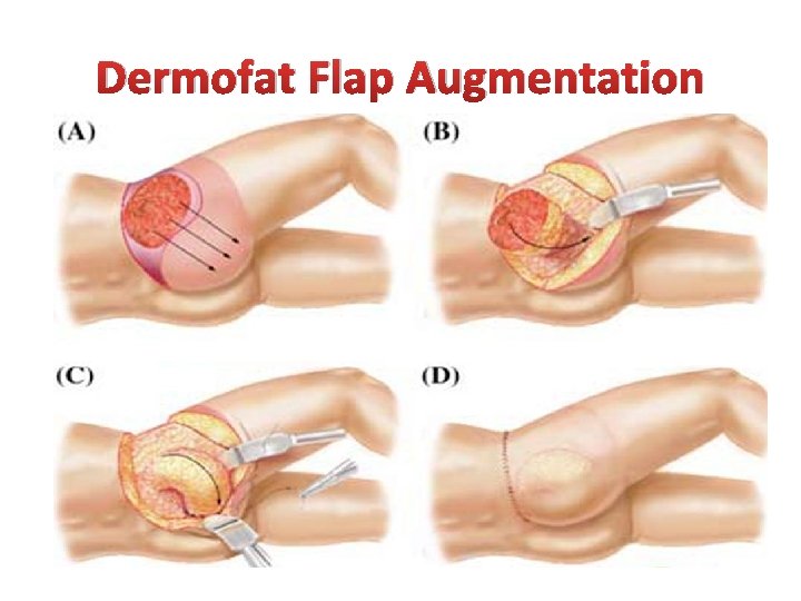 Dermofat Flap Augmentation 