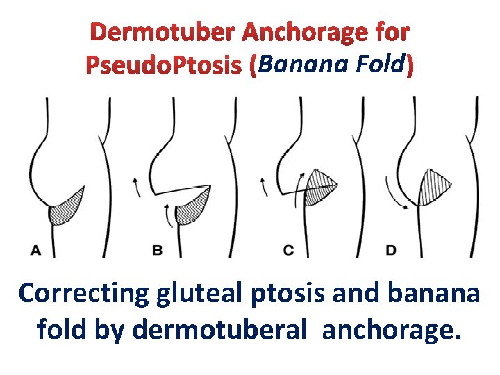 Banana Fold Correcting gluteal ptosis and banana fold by dermotuberal anchorage. 