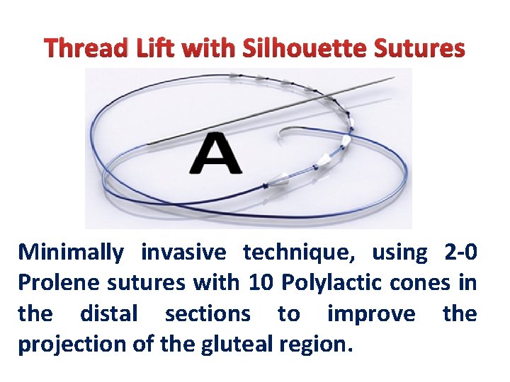 Thread Lift with Silhouette Sutures Minimally invasive technique, using 2 -0 Prolene sutures with