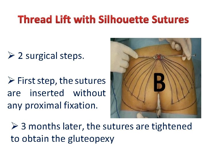 Thread Lift with Silhouette Sutures Ø 2 surgical steps. Ø First step, the sutures