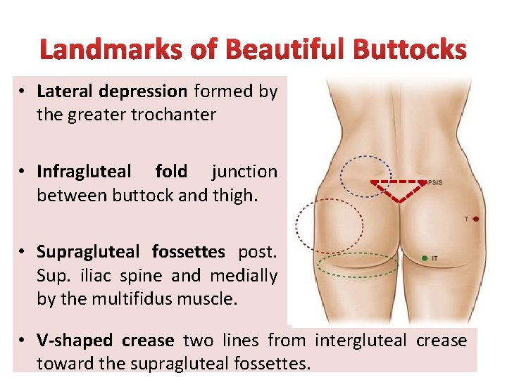 Landmarks of Beautiful Buttocks • Lateral depression formed by the greater trochanter • Infragluteal