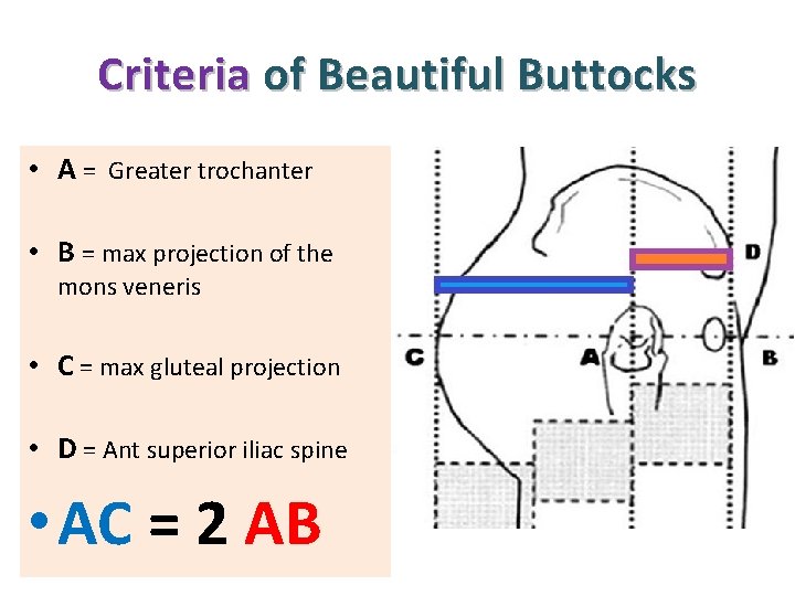 Criteria of Beautiful Buttocks • A = Greater trochanter • B = max projection
