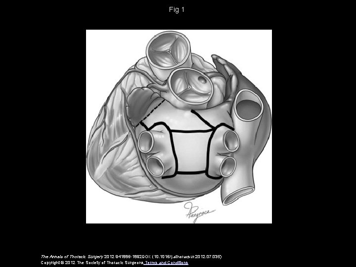 Fig 1 The Annals of Thoracic Surgery 2012 941886 -1892 DOI: (10. 1016/j. athoracsur.