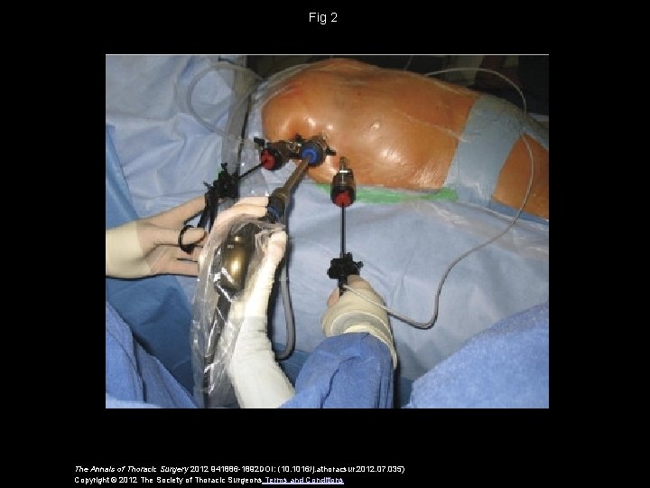Fig 2 The Annals of Thoracic Surgery 2012 941886 -1892 DOI: (10. 1016/j. athoracsur.
