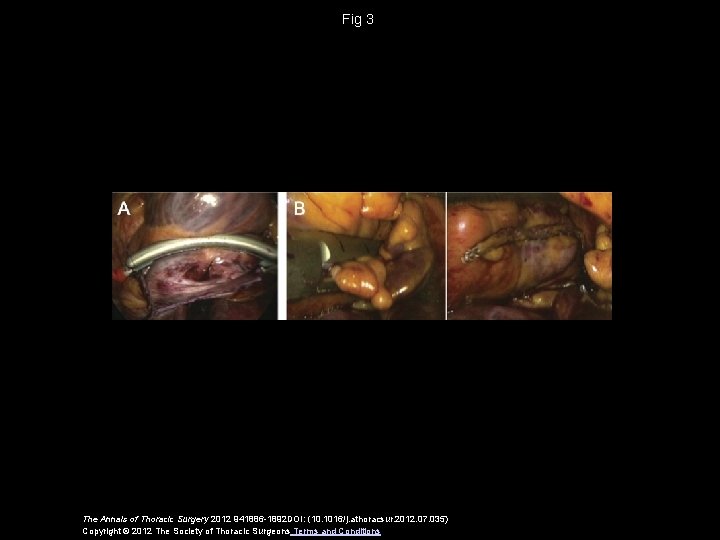 Fig 3 The Annals of Thoracic Surgery 2012 941886 -1892 DOI: (10. 1016/j. athoracsur.