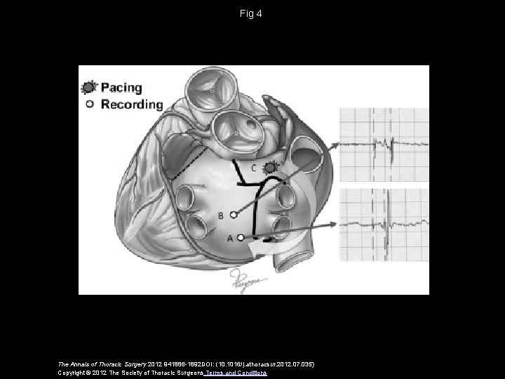 Fig 4 The Annals of Thoracic Surgery 2012 941886 -1892 DOI: (10. 1016/j. athoracsur.