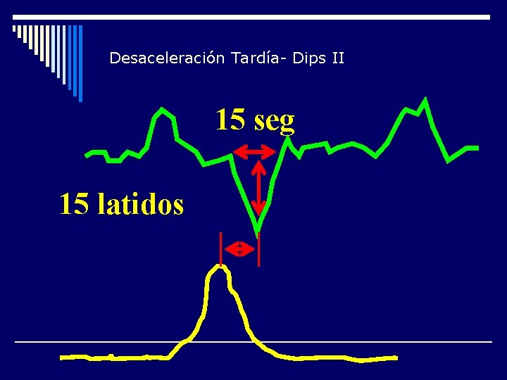 Desaceleración Tardía- Dips II 15 seg 15 latidos 