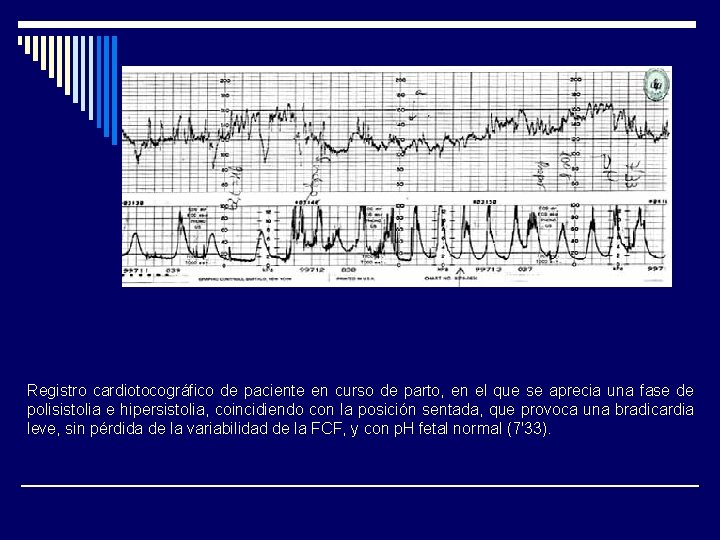 Registro cardiotocográfico de paciente en curso de parto, en el que se aprecia una