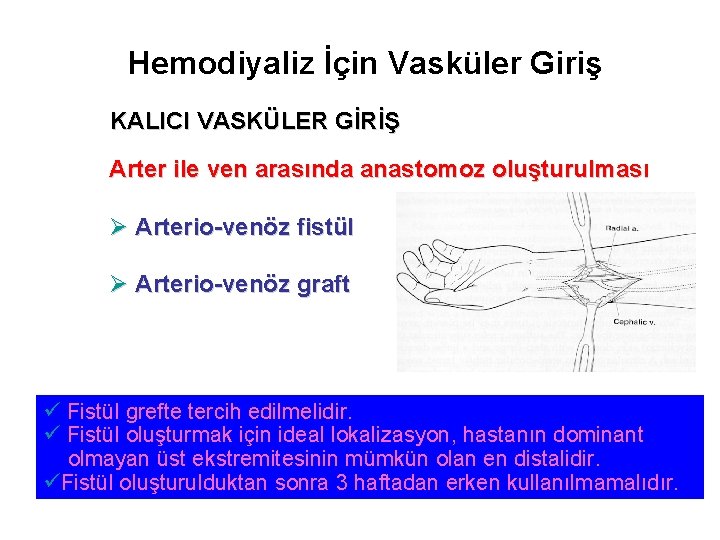 Hemodiyaliz İçin Vasküler Giriş KALICI VASKÜLER GİRİŞ Arter ile ven arasında anastomoz oluşturulması Ø