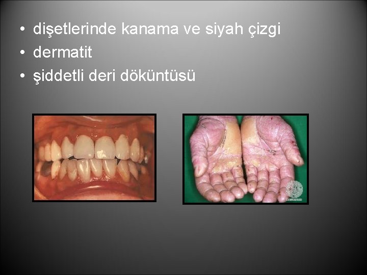  • dişetlerinde kanama ve siyah çizgi • dermatit • şiddetli deri döküntüsü 