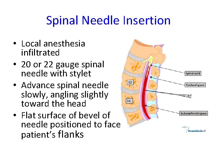 Spinal Needle Insertion • Local anesthesia infiltrated • 20 or 22 gauge spinal needle