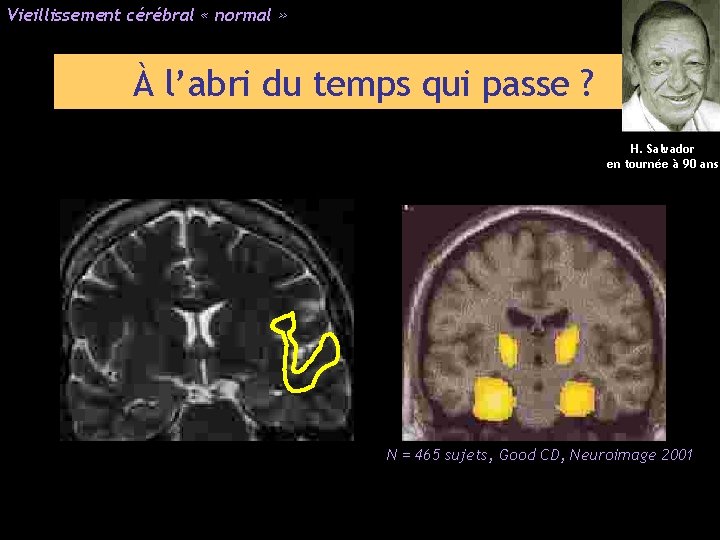 Vieillissement cérébral « normal » À l’abri du temps qui passe ? H. Salvador