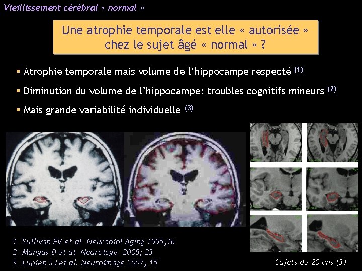 Vieillissement cérébral « normal » Une atrophie temporale est elle « autorisée » chez