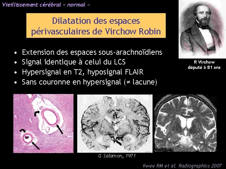 Vieillissement cérébral « normal » Dilatation des espaces périvasculaires de Virchow Robin • •