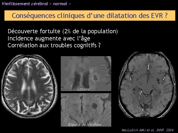 Vieillissement cérébral « normal » Conséquences cliniques d’une dilatation des EVR ? Découverte fortuite