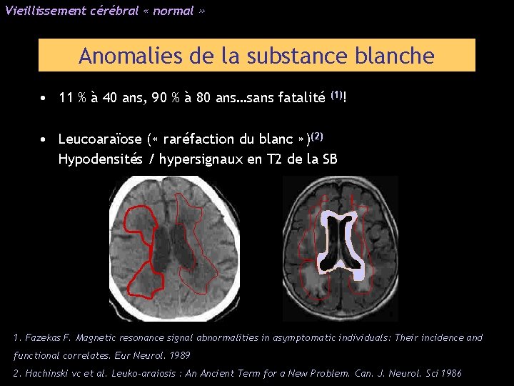 Vieillissement cérébral « normal » Anomalies de la substance blanche • 11 % à