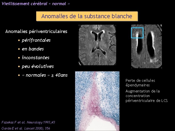 Vieillissement cérébral « normal » Anomalies de la substance blanche Anomalies périventriculaires • périfrontales