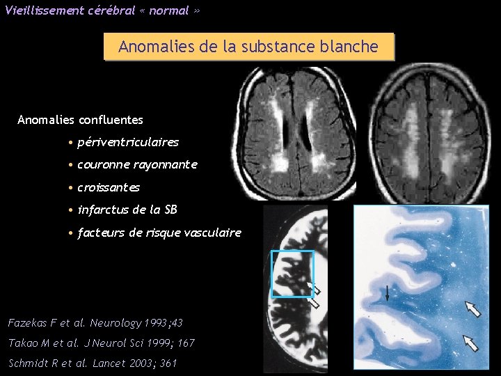 Vieillissement cérébral « normal » Anomalies de la substance blanche Anomalies confluentes • périventriculaires