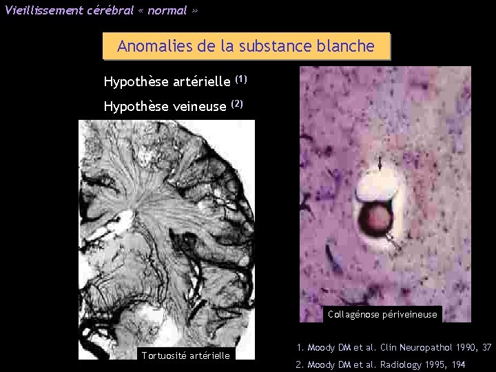 Vieillissement cérébral « normal » Anomalies de la substance blanche Hypothèse artérielle Hypothèse veineuse