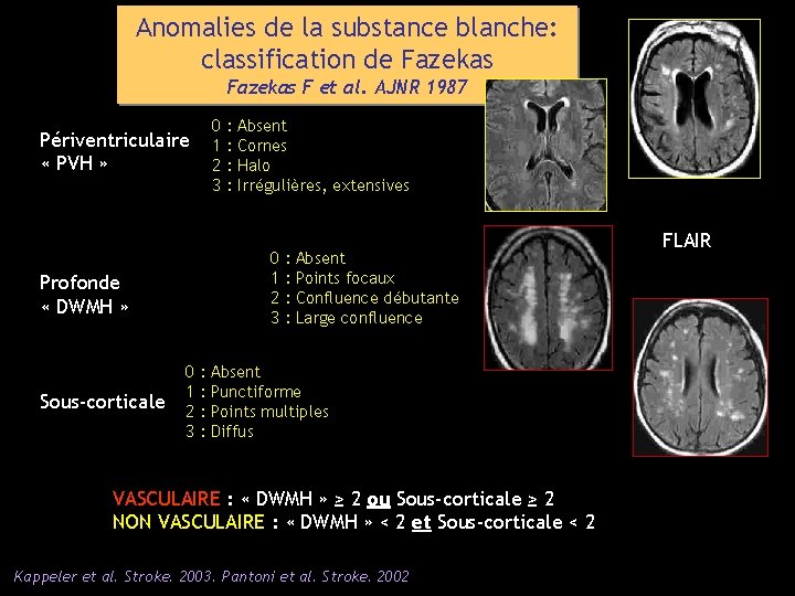 Anomalies de la substance blanche: classification de Fazekas F et al. AJNR 1987 0