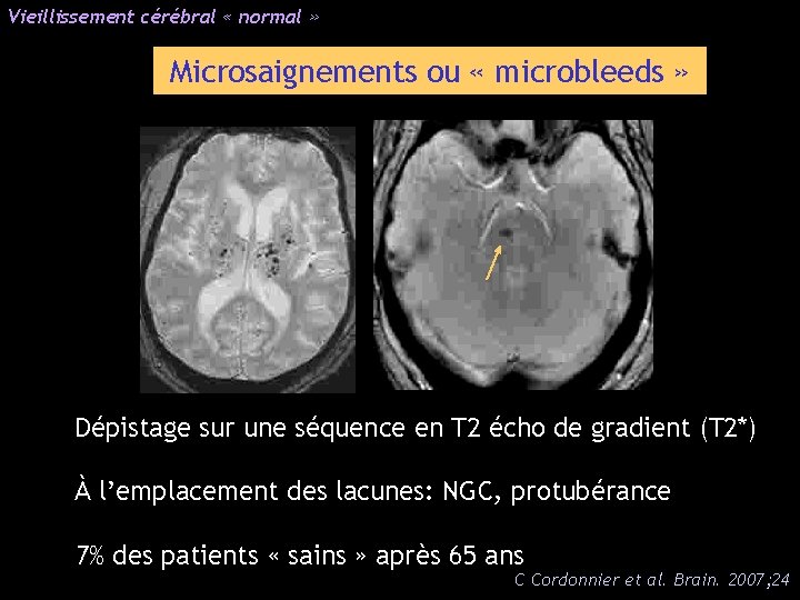 Vieillissement cérébral « normal » Microsaignements ou « microbleeds » Dépistage sur une séquence