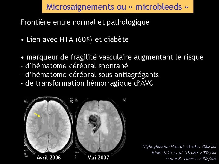 Microsaignements ou « microbleeds » Frontière entre normal et pathologique • Lien avec HTA