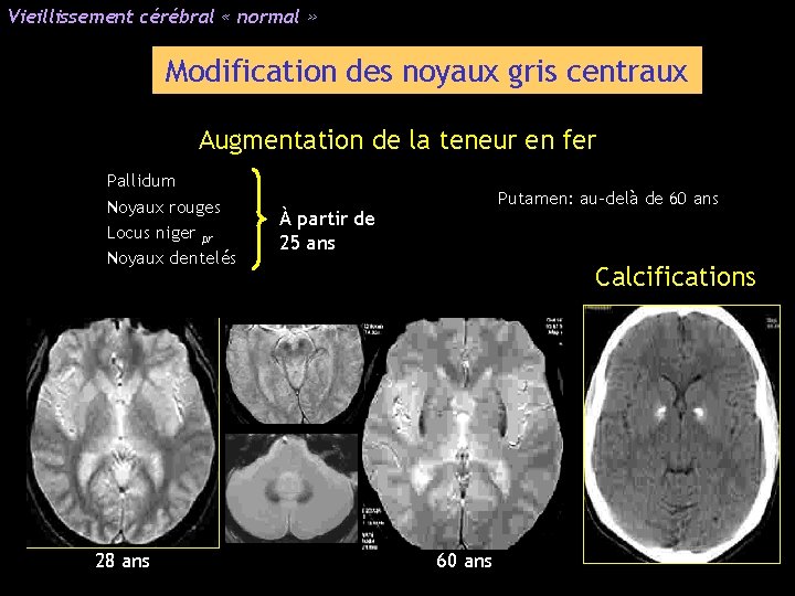 Vieillissement cérébral « normal » Modification des noyaux gris centraux Augmentation de la teneur