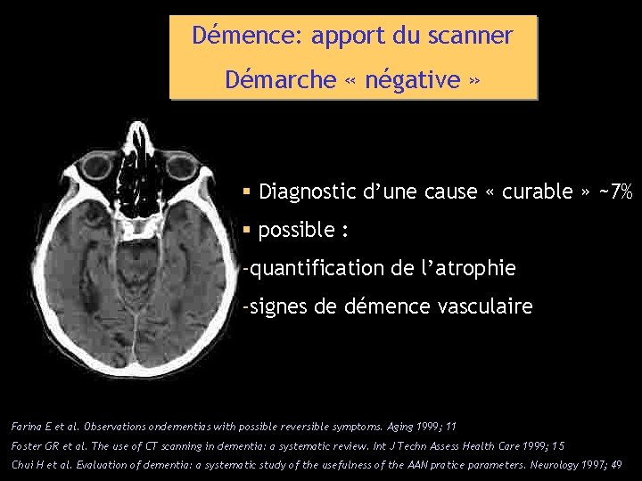 Démence: apport du scanner Démarche « négative » § Diagnostic d’une cause « curable