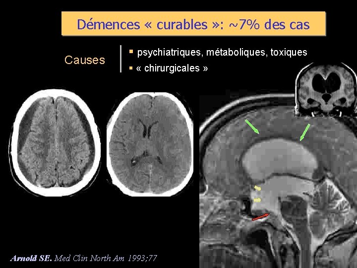 Démences « curables » : ~7% des cas Causes § psychiatriques, métaboliques, toxiques §