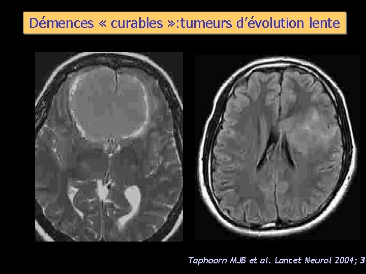 Démences « curables » : tumeurs d’évolution lente Taphoorn MJB et al. Lancet Neurol