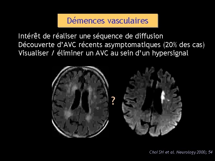 Démences vasculaires Intérêt de réaliser une séquence de diffusion Découverte d’AVC récents asymptomatiques (20%