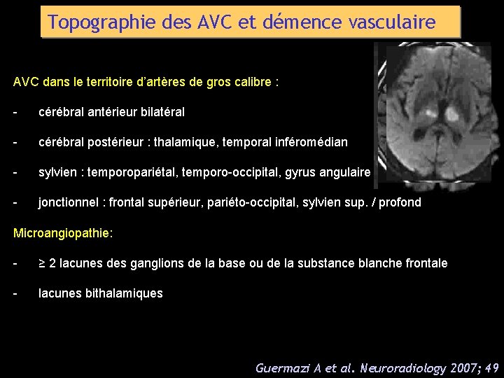 Topographie des AVC et démence vasculaire AVC dans le territoire d’artères de gros calibre