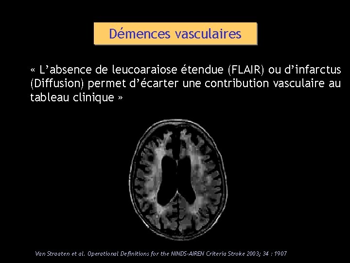 Démences vasculaires « L’absence de leucoaraiose étendue (FLAIR) ou d’infarctus (Diffusion) permet d’écarter une