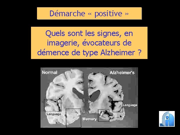 Démarche « positive » Quels sont les signes, en imagerie, évocateurs de démence de