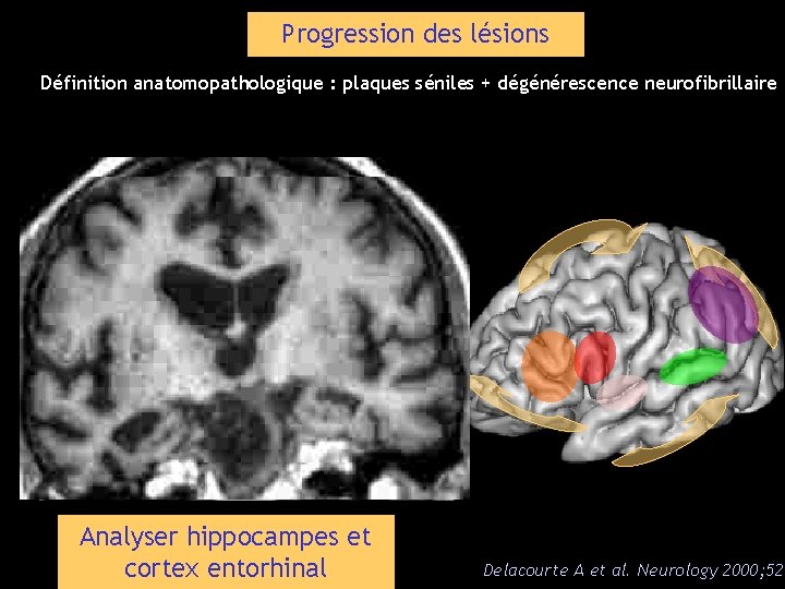 Progression des lésions Définition anatomopathologique : plaques séniles + dégénérescence neurofibrillaire 1 1 1