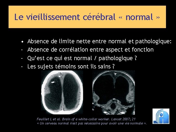 Le vieillissement cérébral « normal » • - Absence de limite nette entre normal