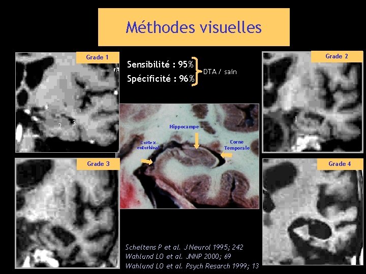 Méthodes visuelles Grade 1 Sensibilité : 95% Spécificité : 96% 2 Grade 2 DTA