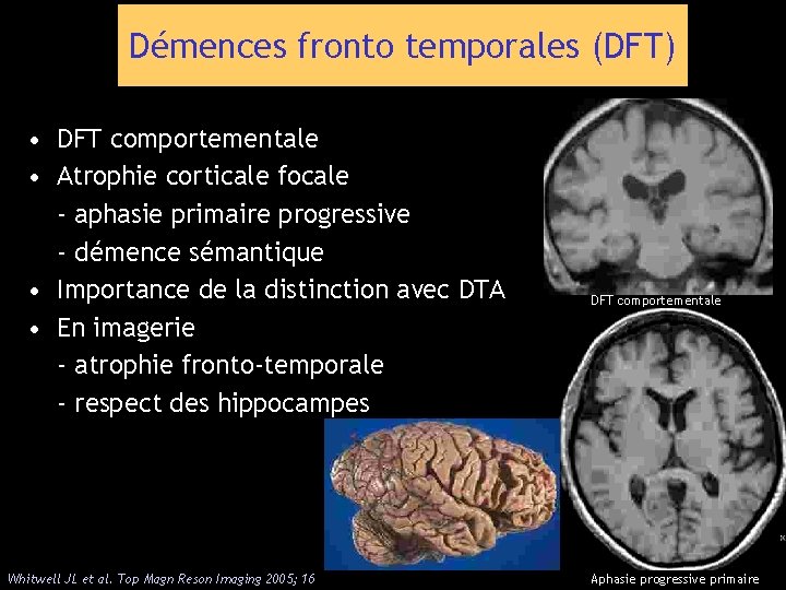 Démences fronto temporales (DFT) • DFT comportementale • Atrophie corticale focale - aphasie primaire