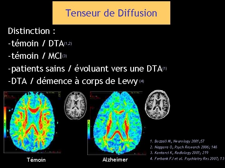 Tenseur de Diffusion Distinction : -témoin / DTA(1, 2) -témoin / MCI(3) -patients sains