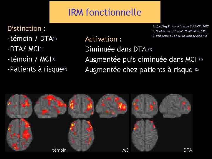 IRM fonctionnelle Distinction : -témoin / DTA(1) -DTA/ MCI(1) -témoin / MCI(1) -Patients à