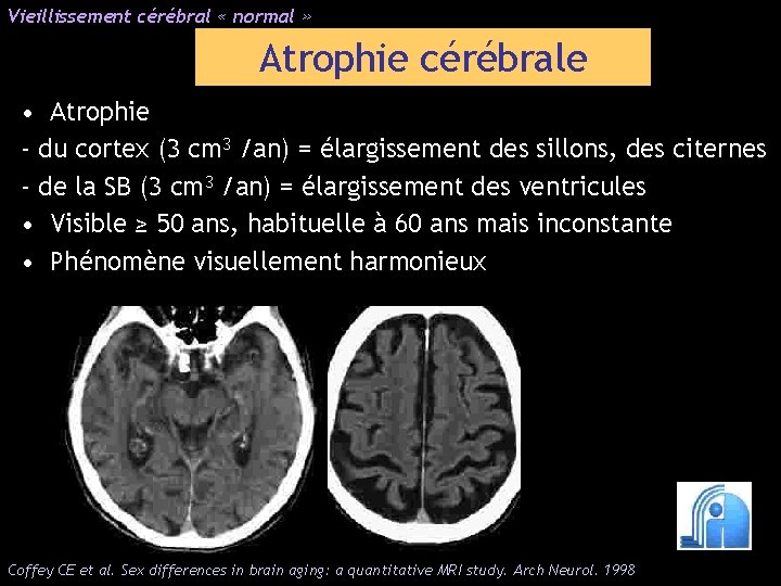 Vieillissement cérébral « normal » Atrophie cérébrale • Atrophie - du cortex (3 cm