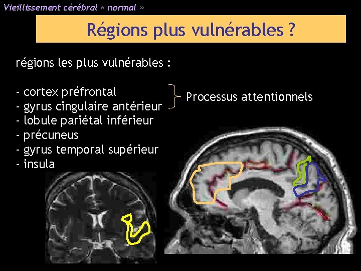 Vieillissement cérébral « normal » Régions plus vulnérables ? régions les plus vulnérables :