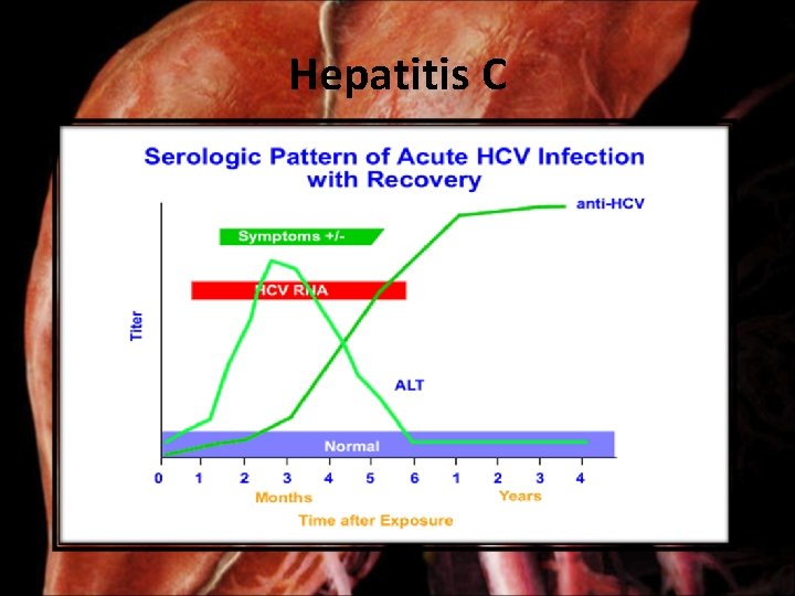 Hepatitis C 