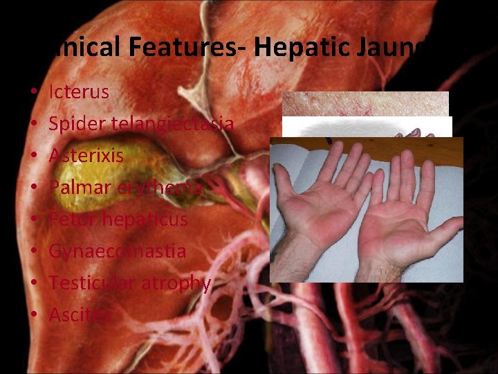 Clinical Features- Hepatic Jaundice • • Icterus Spider telangiectasia Asterixis Palmar erythema Fetor hepaticus
