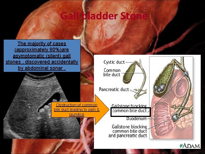 Gall bladder Stone The majority of cases (approximately 80%)are asymptomatic (silent) gall stones ,