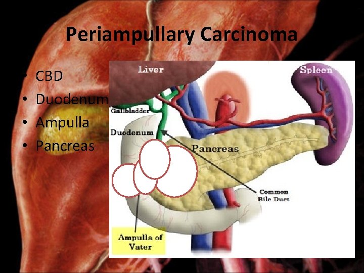 Periampullary Carcinoma • • CBD Duodenum Ampulla Pancreas 