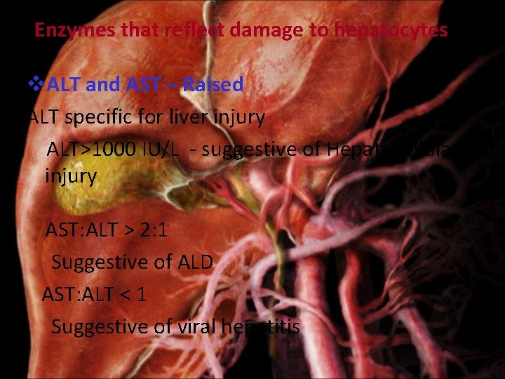 Enzymes that reflect damage to hepatocytes v. ALT and AST – Raised ALT specific