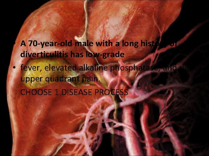  • A 70 -year-old male with a long history of diverticulitis has low-grade