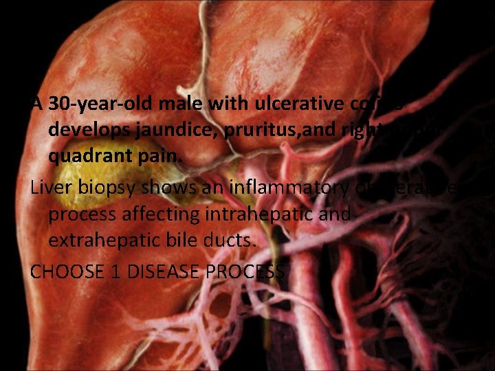 A 30 -year-old male with ulcerative colitis develops jaundice, pruritus, and right upper quadrant